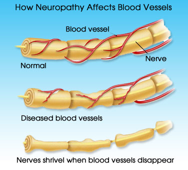neuropathy diagram blood vessels